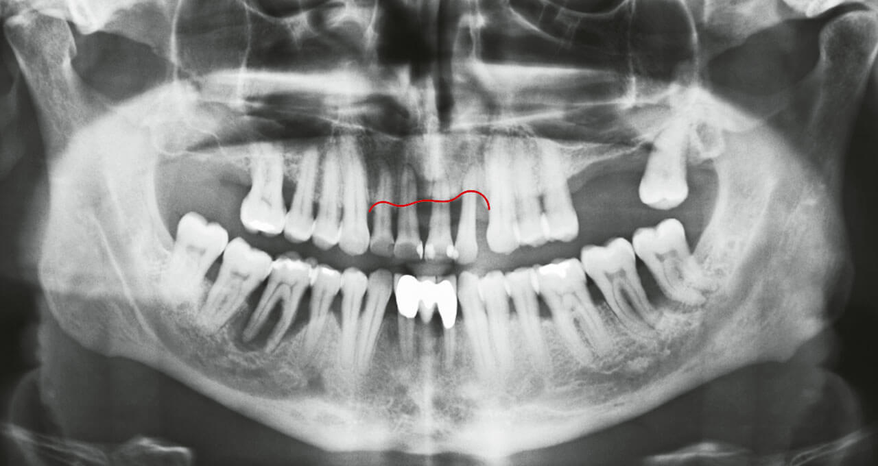 Abb. 2 Radiologischer Ausgangsbefund (OPG). Die rote Markierung indiziert den stark reduzierten ossären Kamm­verlauf in der Oberkieferfront.