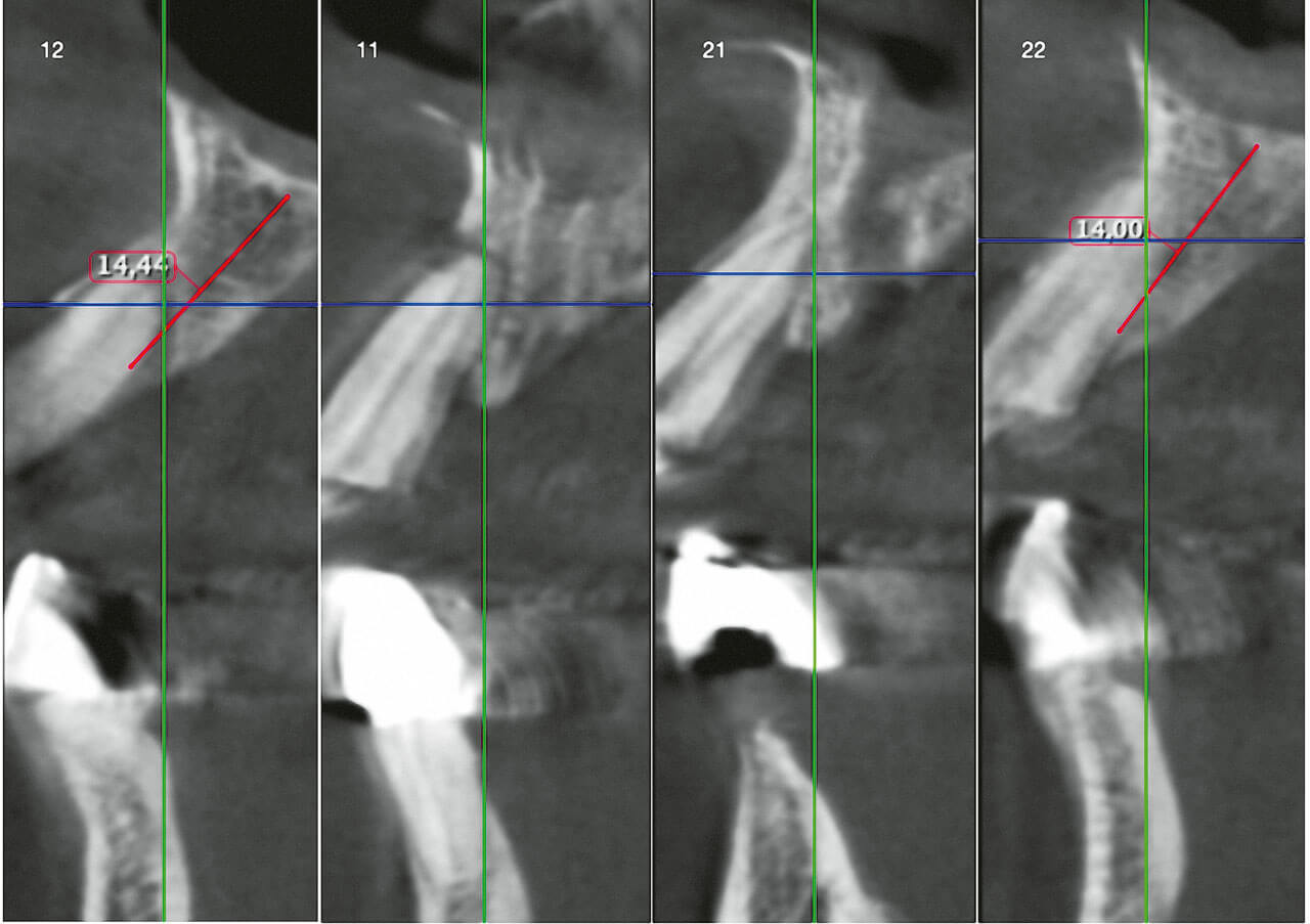 Abb. 3 Radiologischer Ausgangsbefund (DVT), Schnittbilder der Oberkieferfront.