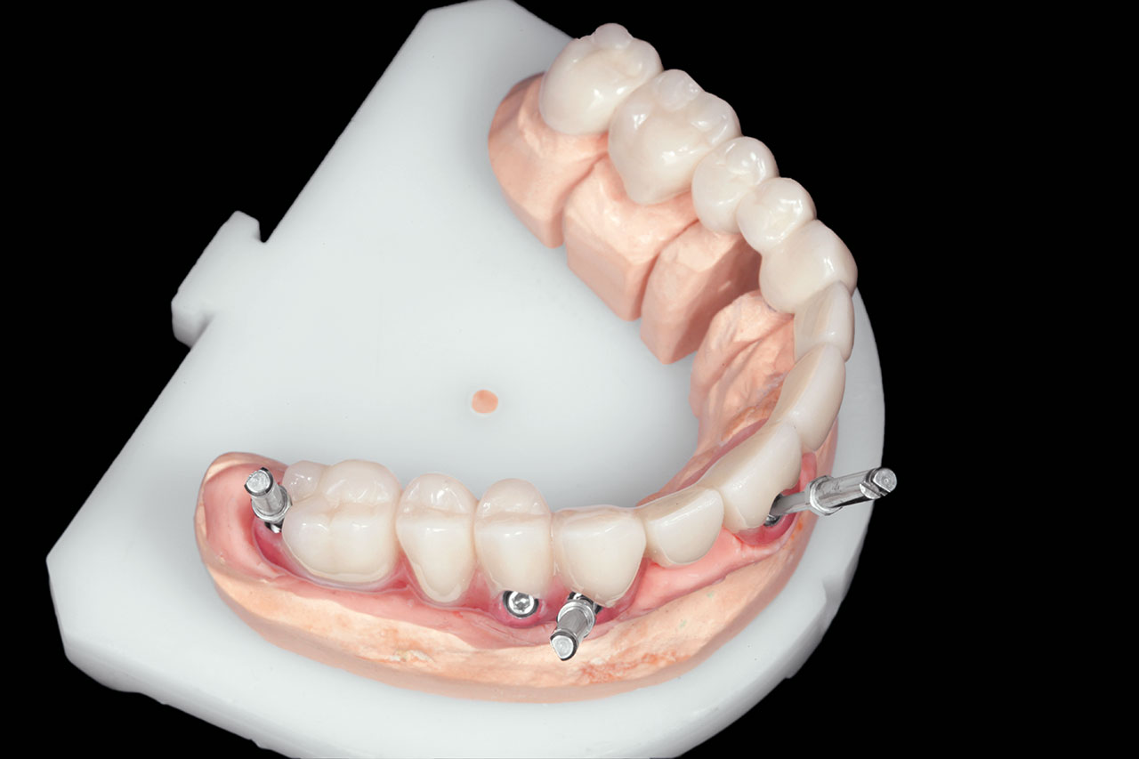 Abb. 2 Lokalisation und Einschubrichtung der gesetzten Implantate in Relation zur Lage der natürlichen Zahnreihe (Bild: Taskin Tuna).