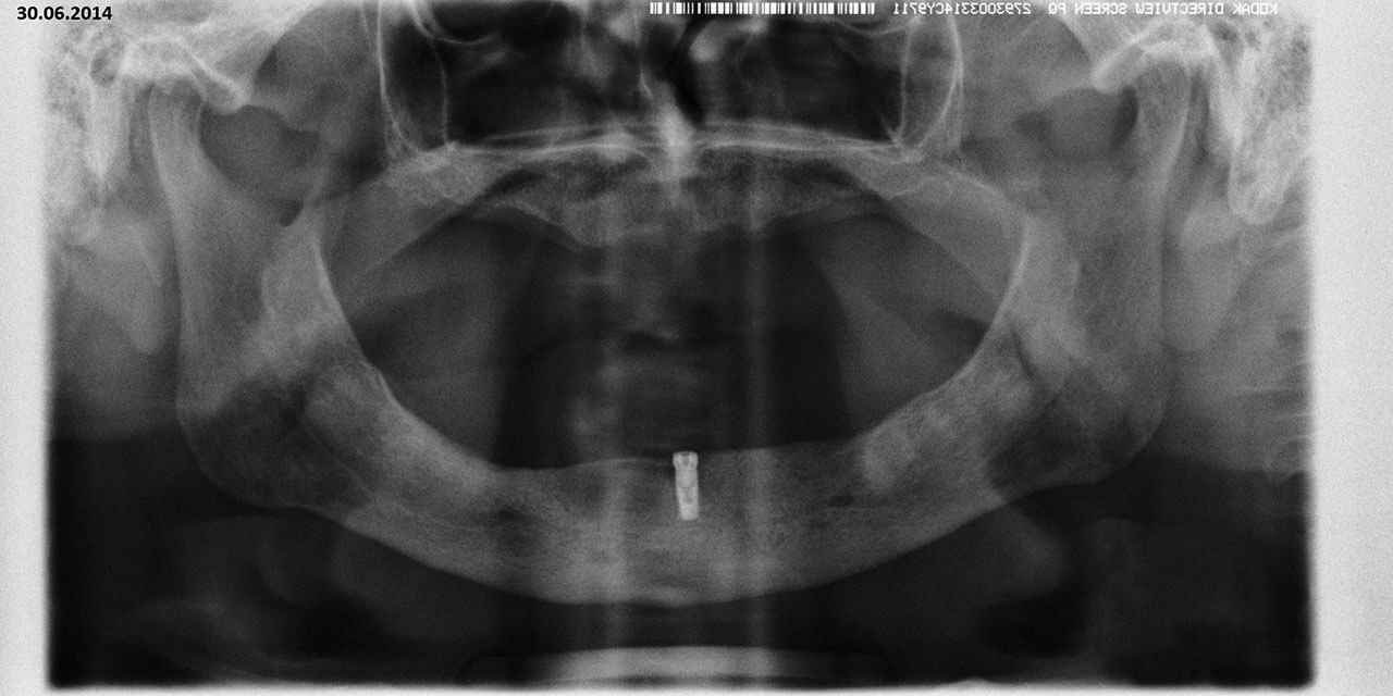 Abb. 15 Röntgenologische Kontrolle nach erneuter Implantation mit geschlossener Einheilung etwa 4 Monate nach Verlust des ersten Implantats.
