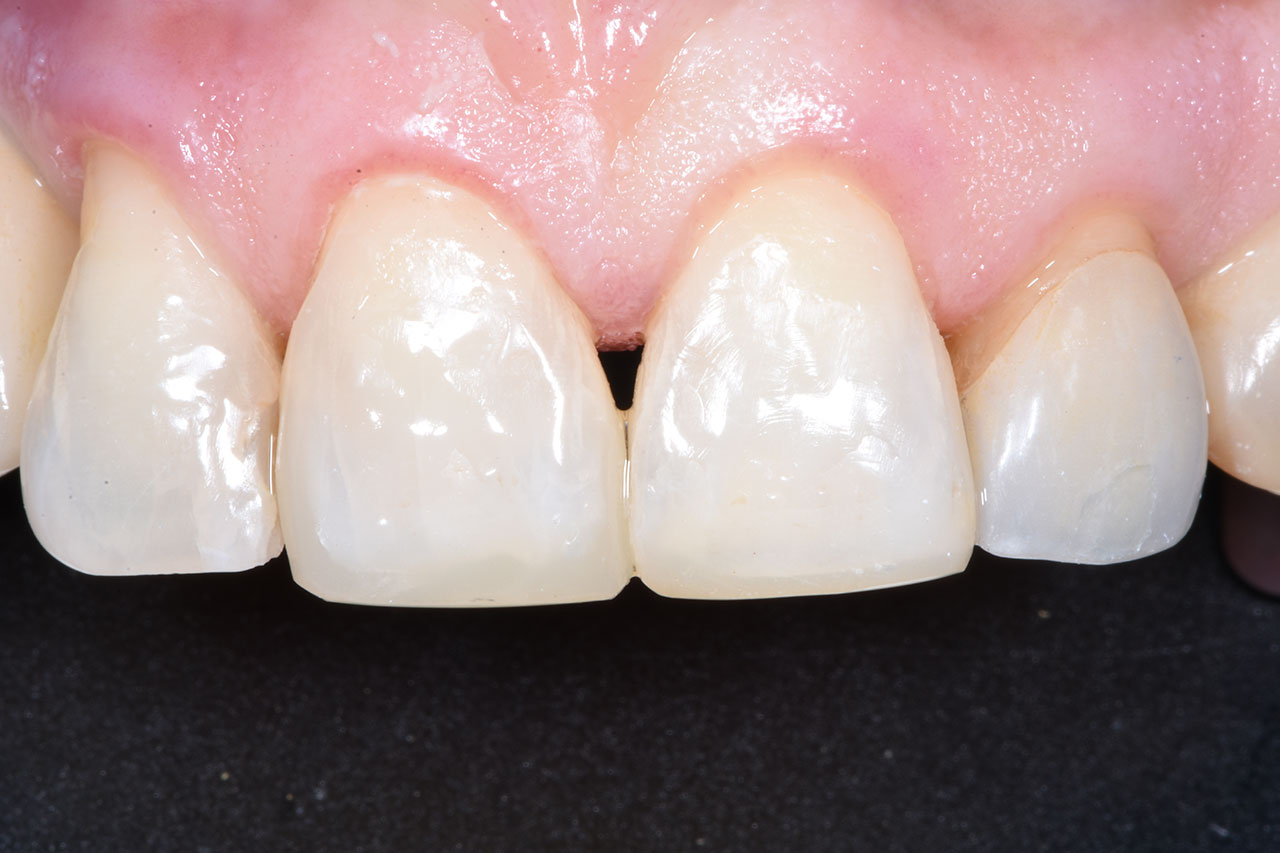 Abb. 6. Zustand direkt postoperativ. Durch die Austrocknung und damit einhergehende Aufhellung der Zahnhartsubstanz während der Restauration erscheinen die Füllungen typischerweise postoperativ zu dunkel und zu transluzent.
