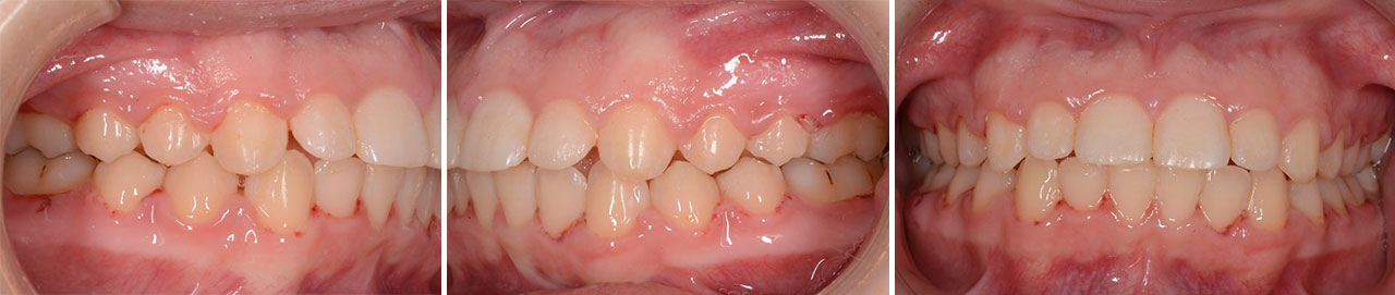 Abb. 5b Nach Entfernung der Brackets. Die kieferorthopädische Behandlung dauerte 19 Monate. Die Zähne zeigten keinerlei Schmelzdemineralisierung, obschon eine unbedeutende Gingivaschwellung bestand.