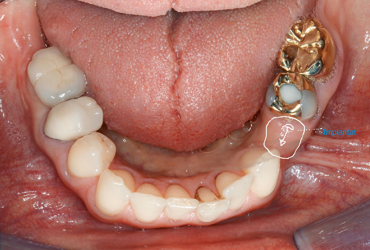 Abb. 3a bis e Klinischer Ausgangsbefund mit initialer Planung der Mittenkorrektur im Oberkiefer (Extraktion des Zahns 15 und Lückenversorgung eines Implantats in Regio 35).