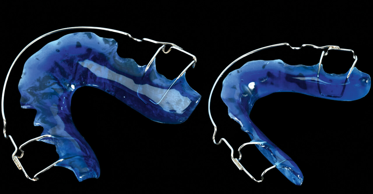 Abb. 1 Konventionell (gestreut) hergestellte Modifikation des Hawley-Retainers für den oberen und unteren Zahnbogen. Für den Halt der Apparatur dienen Adamsklammern. 