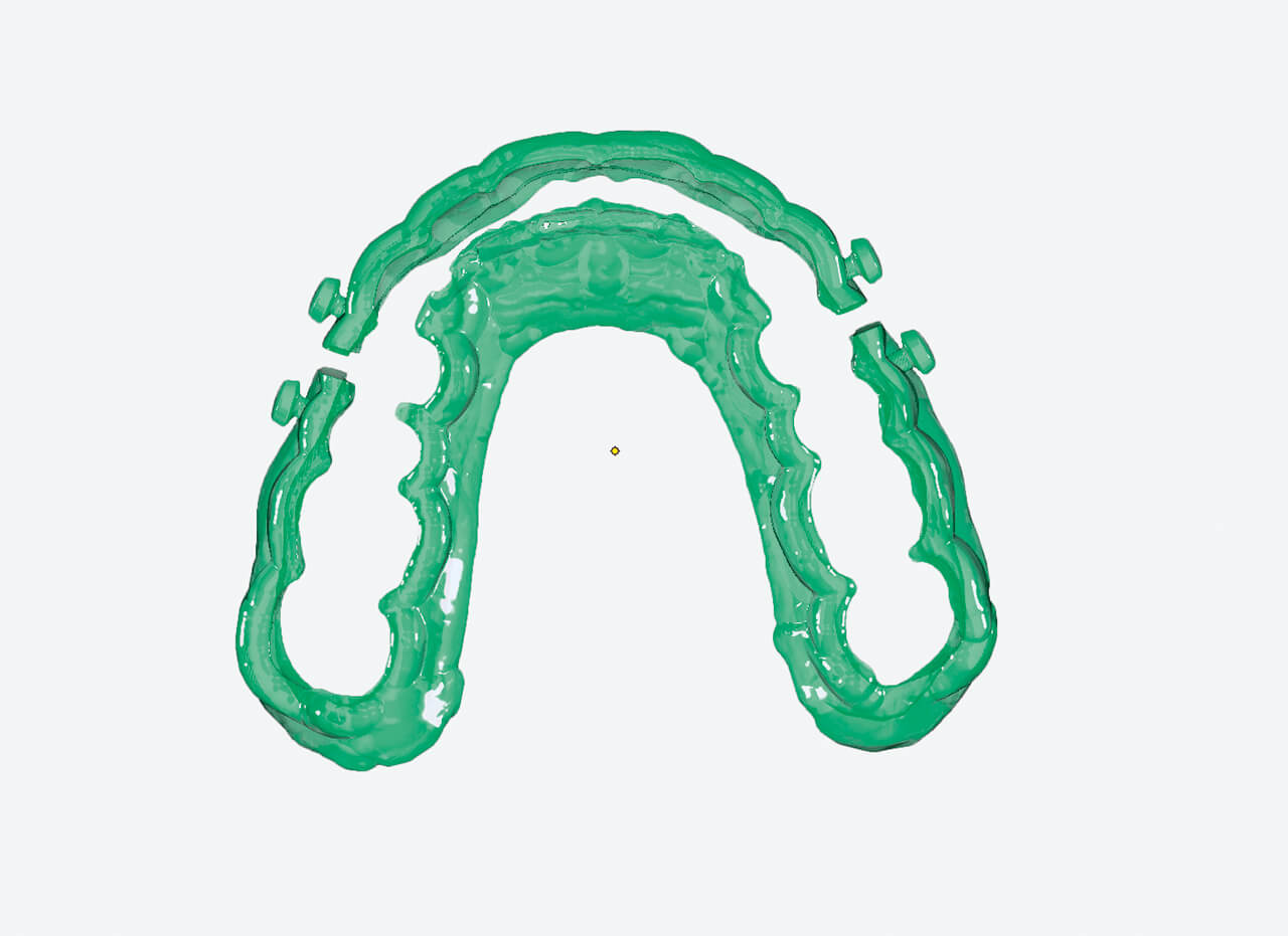 Abb. 3 CAD-Zeichnung eines 3-D-gedruckten Hawley-Retainers mit beweglichem Labialschild. Um eine zusätzliche Retentions­steigerung beziehungsweise Aktivierungsmöglichkeit zu ­erzielen, kann ein Labialschild gestaltet werden, welches mit dem Plattenkörper distal der Eckzähne durch Gummiketten elastisch verbunden wird. 