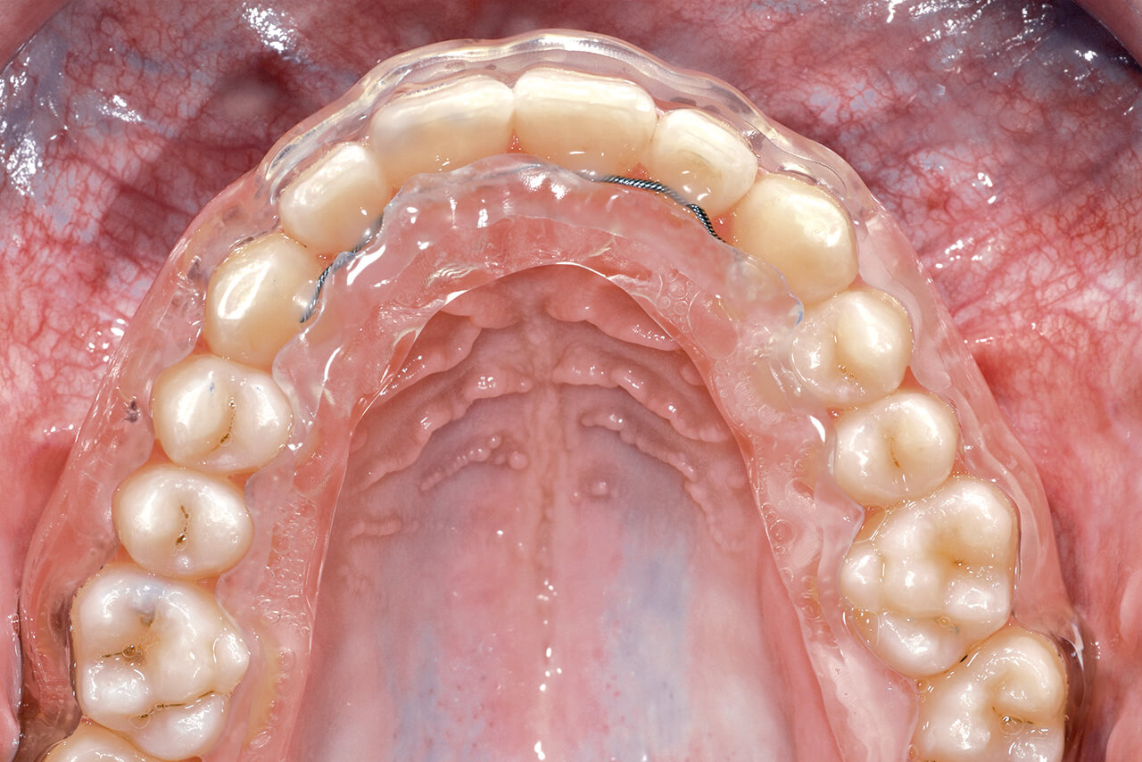 Abb. 5 Klinisches Bild vom eingesetzten 3-D-gedruckten ­Hawley-Retainer im oberen Zahnbogen. Der Scan erfolgte nach dem Einsetzen des Oberkieferretainers (in Regio 13 bis 23), um eine optimale Passung und Retention zu erzielen. 