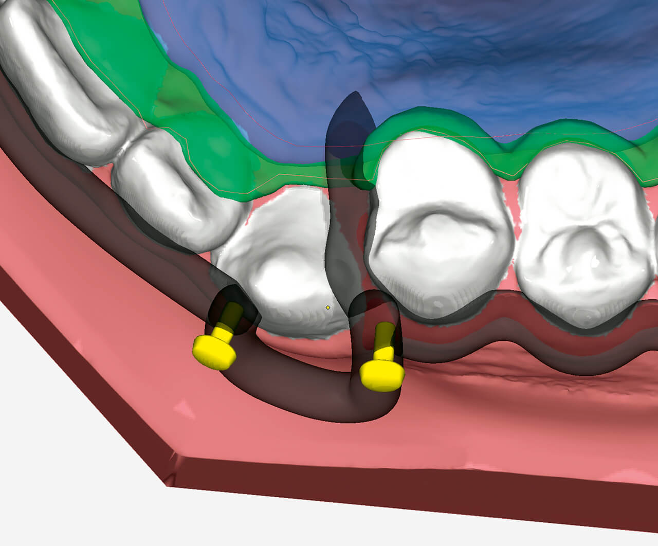 Abb. 8 Gestaltung der individuellen Hooks am Labialbogen. Um die Platte ­aktivieren zu können oder Gummizüge einzuhängen, können die hier abgebildeten Hooks hinzugefügt werden. Diese stehen in der Bibliothek der Software OnyxCeph vorgefertigt zur Verfügung. 