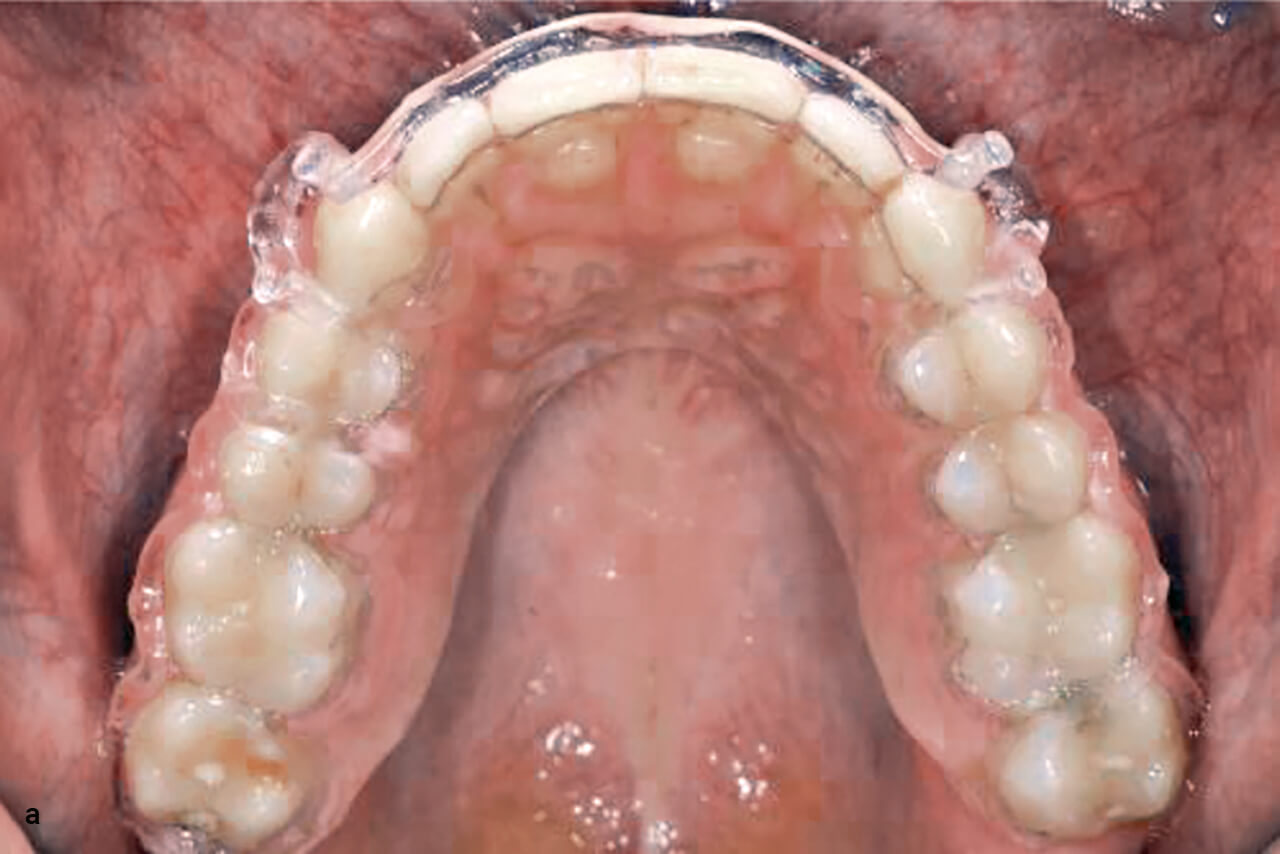Abb. 11a Klinische Bilder von gefrästen Hawley-­Retainern. Oberer Zahnbogen.
