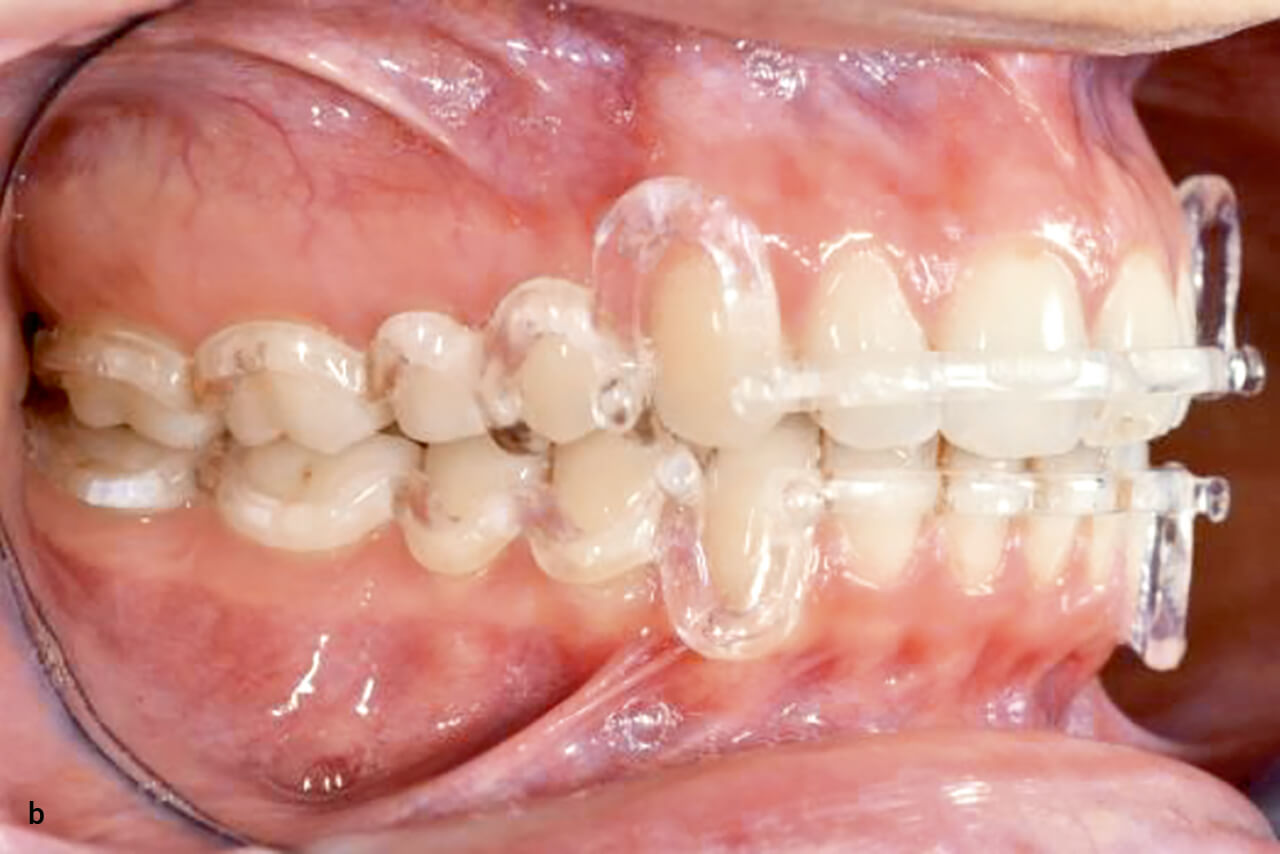 Abb. 11b Klinische Bilder von gefrästen Hawley-­Retainern. Okklusionsansicht rechts.