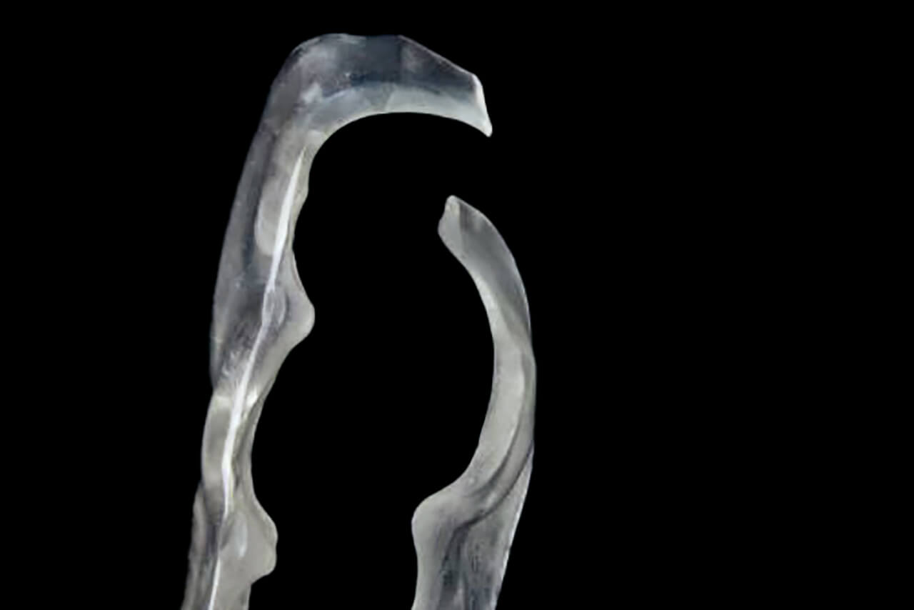 Abb. 12 Dorsale Bruchstelle eines mittels Dental Clear LT (Fa. Formlabs) 3-D-­gedruckten Hawley-Retainers. Durch den entstehenden Vorkontakt distal ­der Unterkiefermolaren kann es in diesem Bereich zu Frakturen des Materials kommen. 