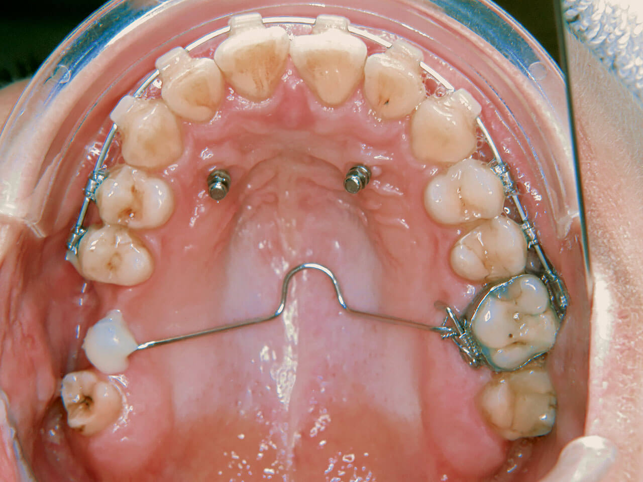 Abb. 4 Oberkieferaufsicht nach erfolgter chirurgischer GNE und Ausformung des Zahnbogens mit TPB zur Retention.