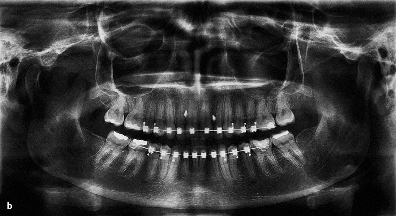 Abb. 1b Nach der kieferorthopädischen Behandlung, vor der ­Entbänderung.