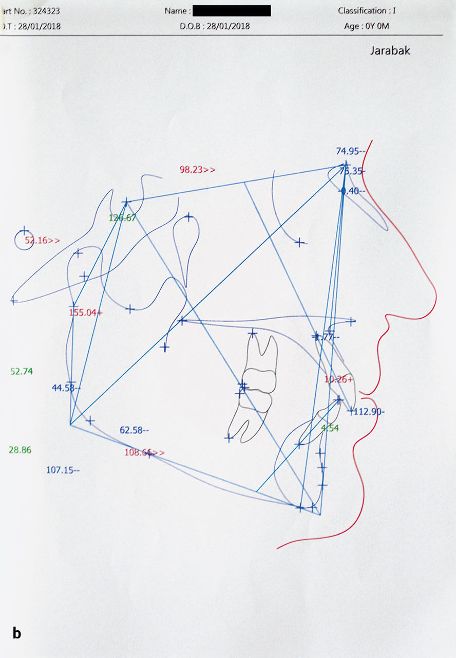 Abb. 3a und b Jarabak-Analyse des seitlichen Fernröntgenbildes vor der Behandlung (a), Durchzeichnung (b).