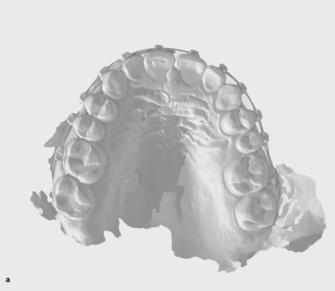 Abb. 6a und b Intraoraler Scan nach der kieferorthopädischen Behandlung (vor der Entbänderung).