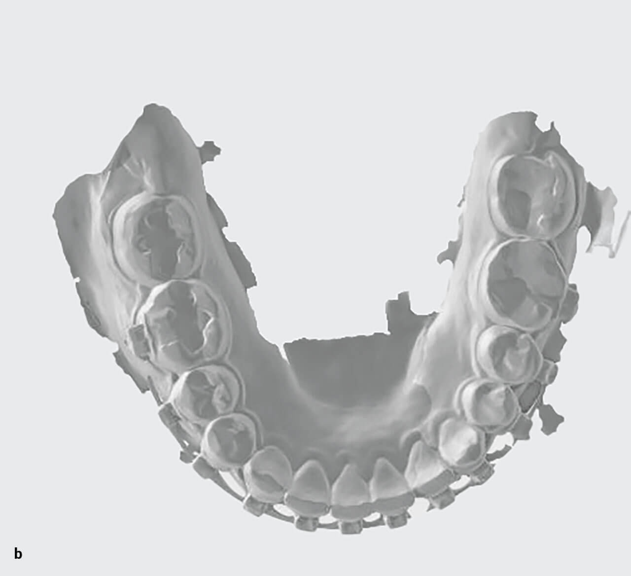 Abb. 6a und b Intraoraler Scan nach der kieferorthopädischen Behandlung (vor der Entbänderung).