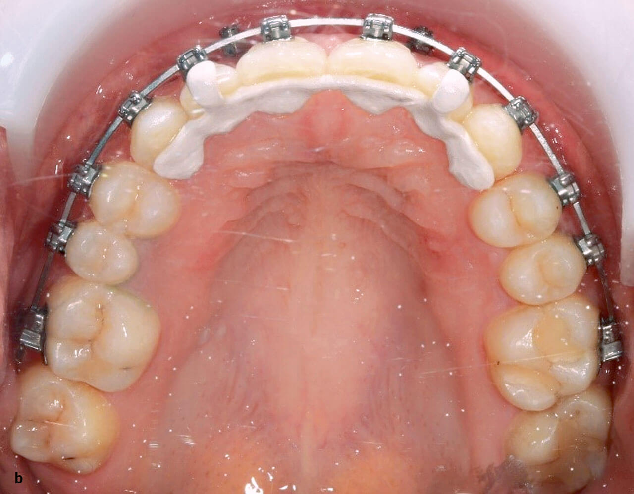 Abb. 12b Und nach der kieferorthopädischen ­Behandlung inklusive festsitzendem Retainer.