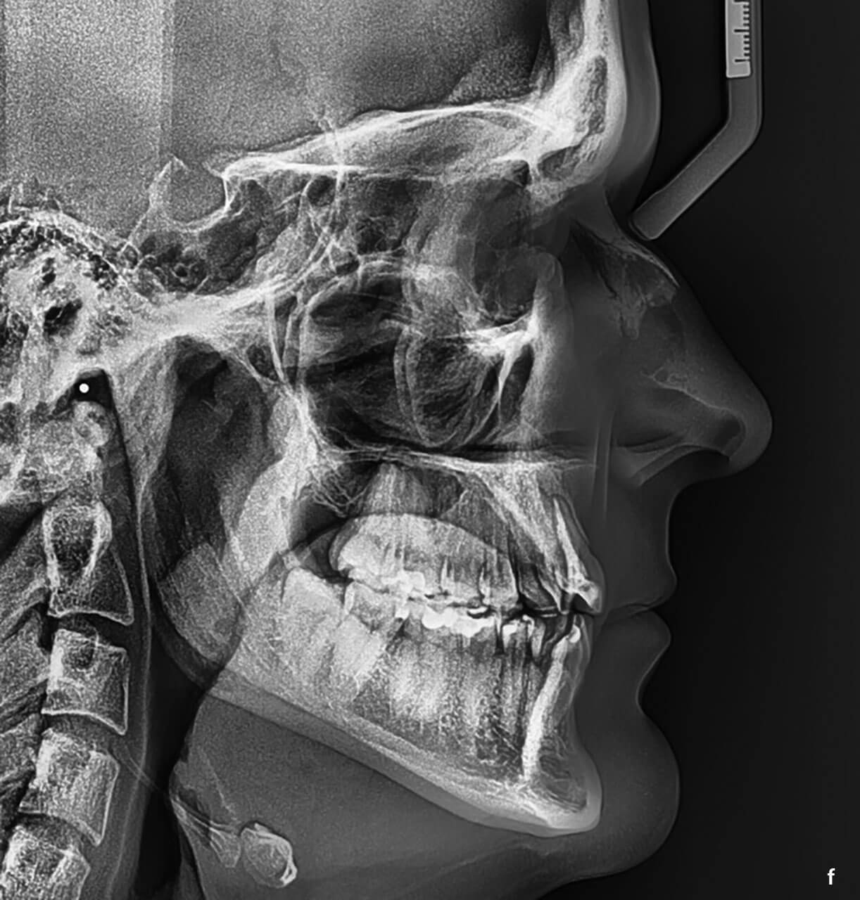 Abb. 1a bis g Klinische und radiologische Ausgangssituation vor Beginn der kieferorthopädischen Behandlung.