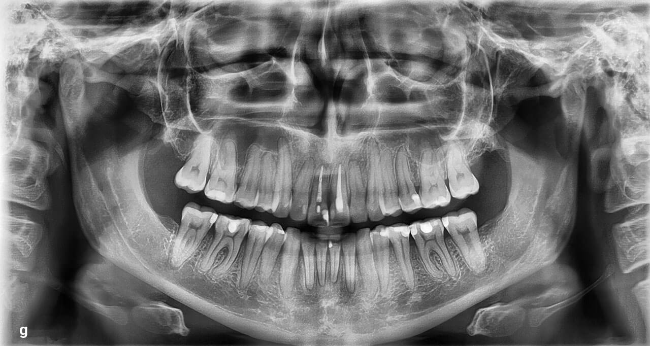 Abb. 4a bis g Klinischer und radiologischer Zustand nach erfolgreich überstellter Kreuzbisssituation im Front- und Seitenzahnbereich. Gerade beim Vergleich der Frontalansichten zu Behandlungsbeginn (s. Abb. 1a) mit Behandlungsabschluss (a) wird deutlich, dass weder eine kompensatorische Bukkalkippung der Seitenzähne im Oberkiefer noch eine kompensatorische Lingualkippung der Seitenzähne im Unterkiefer stattgefunden hat. Die Inklination der Seitenzähne wirkt daher nicht übermäßig kompensiert. Auch die bereits vor Beginn der kieferorthopädischen Behandlung existierenden Rezessionen in Regio 16 und 26 wurden aufgrund der Zahnbewegung nicht vergrößert (b und c). Die Aufbissaufnahmen (d und e) zeigen die zuverlässige Umsetzung der individuellen Planung.