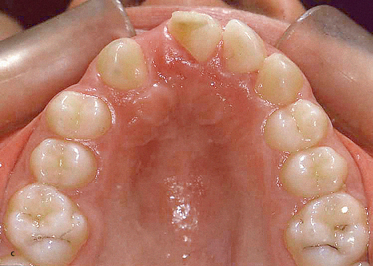Abb. 1 Die Patientin stellte sich im Alter von 11 Jahren nach einem traumatischen Verlust der Zähne 11 und 12 vor.