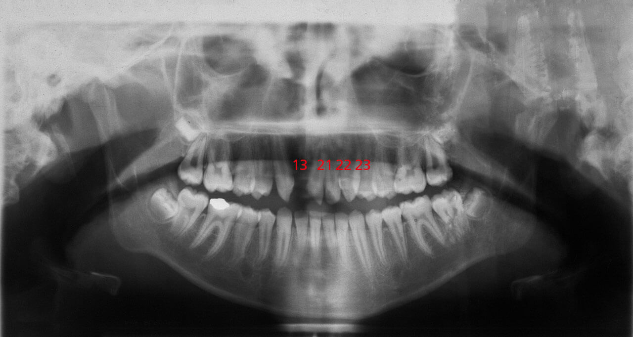 Abb. 2 Röntgenbild bei der kieferorthopädischen Erstkonsultation.