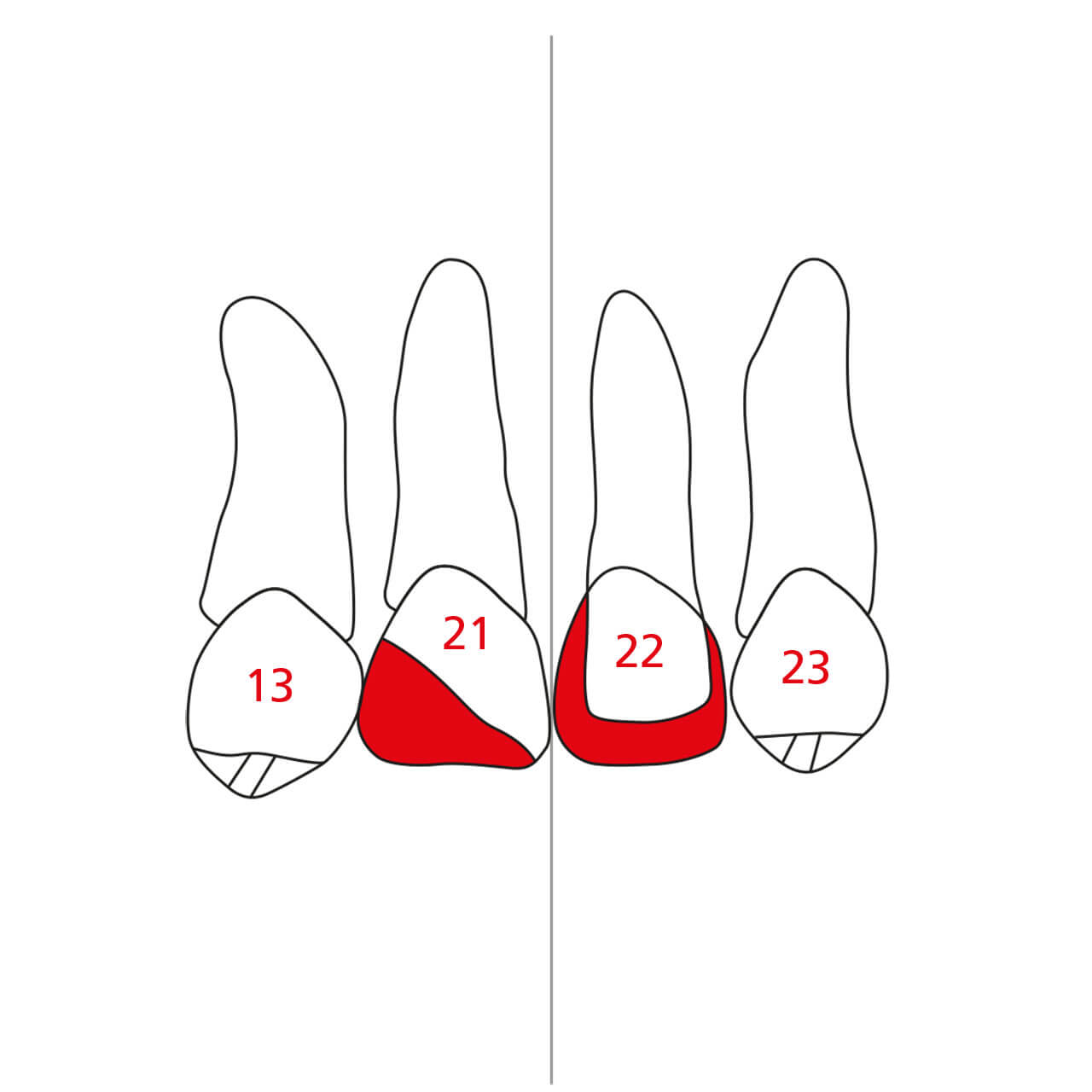Abb. 3a und b Skizzierung der gewünschten/geplanten kieferorthopädischen Zahnbewegung.