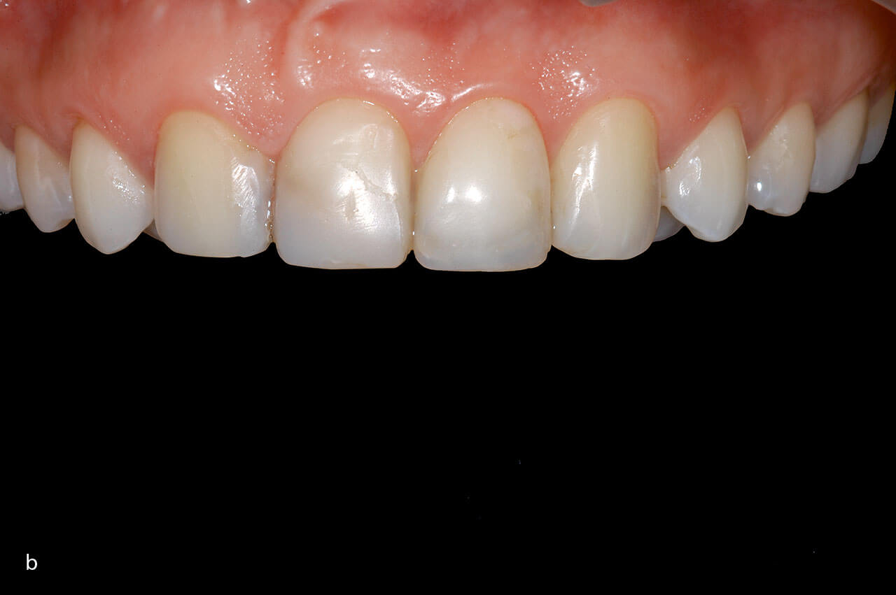 Abb. 6a bis c Finishing: Kieferorthopädisch, parodontal-chirurgisch, konservierend, prothetisch.