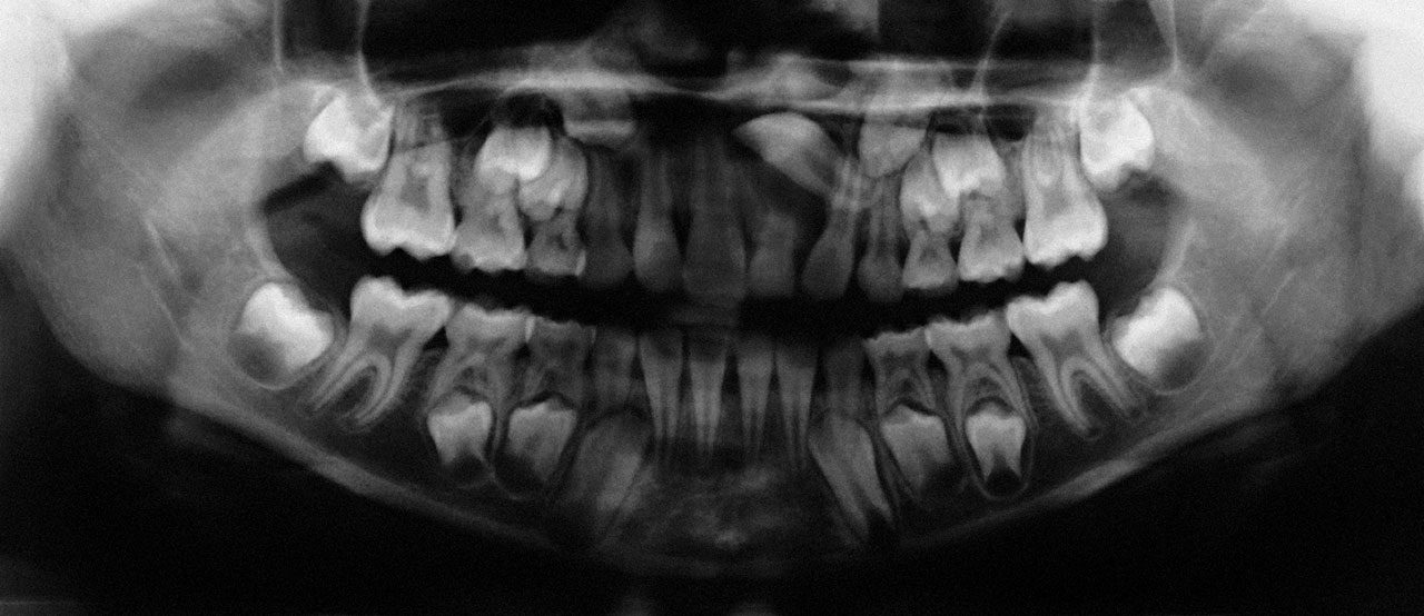 Abb. 2 Im OPG sind alle Zahnanlagen nachweisbar. Es besteht ein altersgerechter Stand der Gebissentwicklung. Auffällig ist ein nach kranial verlagerter Zahn 21 mit ausgeprägter Wurzeldilazeration und Persistenz von Zahn 61 mit unvollständiger Wurzelresorption. Zusätzliche Zahnanlagen sind nicht nachweisbar. Es besteht eine signifikante alveoläre Deformation in Regio 21.