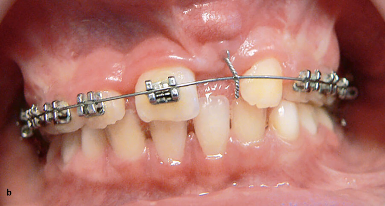 Abb. 7a bis c Nach der Extraktion des Zahnes 61 und der operativen Freilegung des Zahnes 21 erfolgte durch ­Teilbogen­technik innerhalb der ersten acht Monate die vorsichtige vertikale Entwicklung des Zahnes 21 mit klinisch erkennbarer ­Verbesserung (Schneidekante tast- und sichtbar).