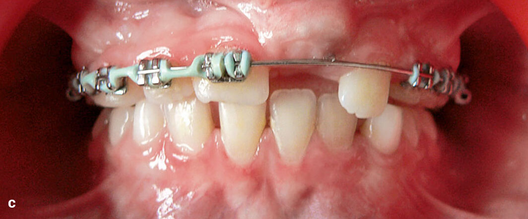 Abb. 7a bis c Nach der Extraktion des Zahnes 61 und der operativen Freilegung des Zahnes 21 erfolgte durch ­Teilbogen­technik innerhalb der ersten acht Monate die vorsichtige vertikale Entwicklung des Zahnes 21 mit klinisch erkennbarer ­Verbesserung (Schneidekante tast- und sichtbar).