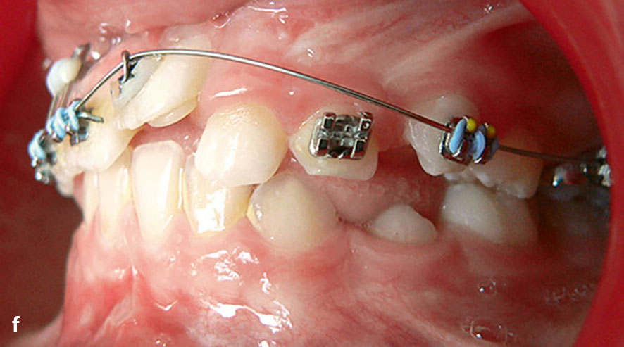 Abb. 8a bis g FRS, intraorale Befunde und OPG im weiteren Behandlungsverlauf. Nach Umsetzen des Attachments von Zahn 21 erfolgte unter ossärer Verankerung die schrittweise Einstellung.