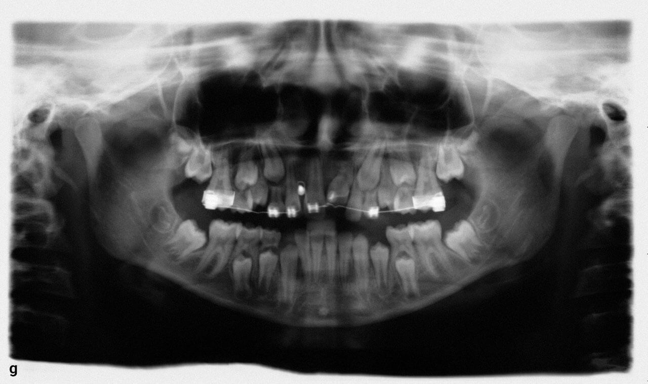 Abb. 8a bis g FRS, intraorale Befunde und OPG im weiteren Behandlungsverlauf. Nach Umsetzen des Attachments von Zahn 21 erfolgte unter ossärer Verankerung die schrittweise Einstellung.