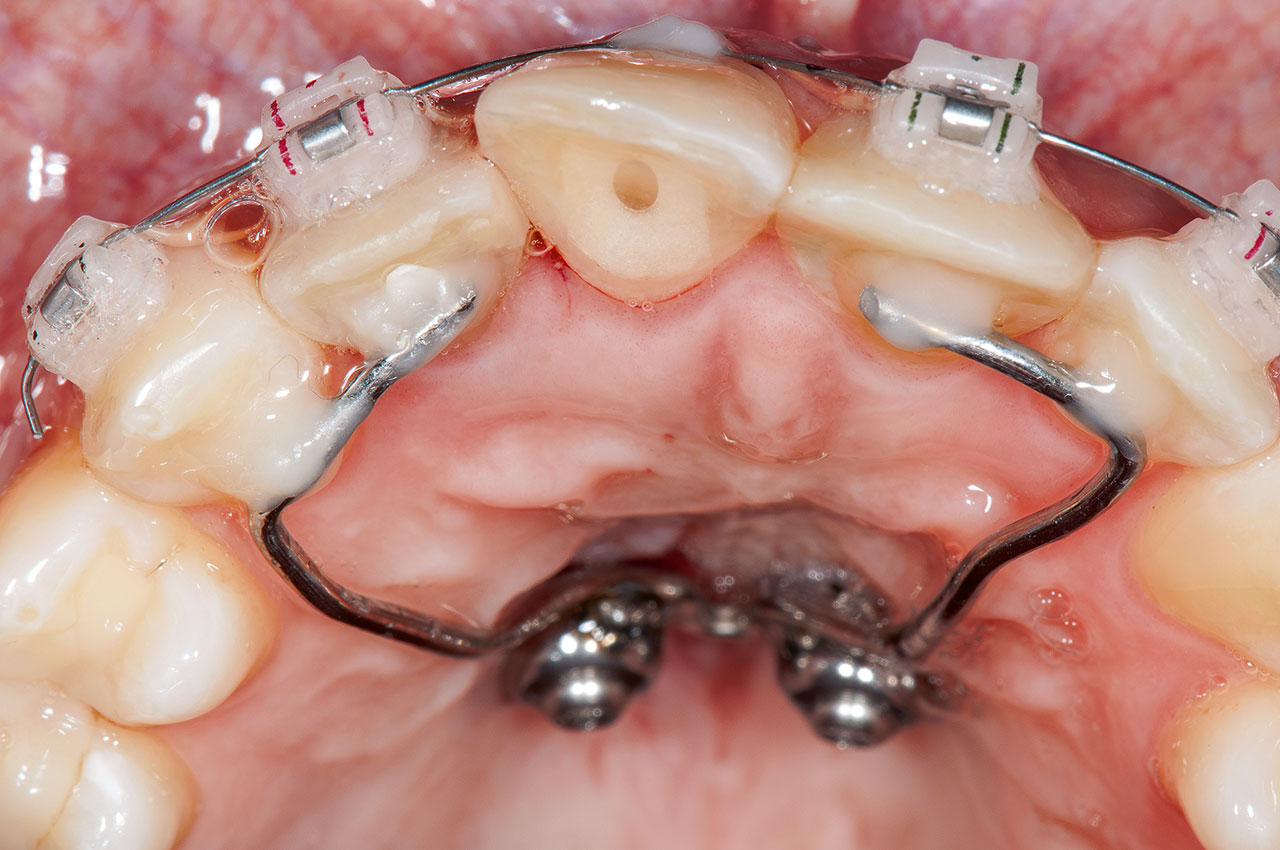 Abb. 6 Extrusion von Zahn 11 mithilfe der Herstellung einer indirekten Verankerungseinheit an palatinal gesetzten Miniimplantaten.