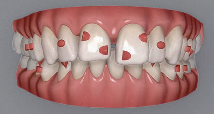 Abb. 1: Die zur Kraftsteuerung dienenden Attachments werden im virtuellen Verfahren auf die Zähne eines virtuellen Modells adaptiert.
