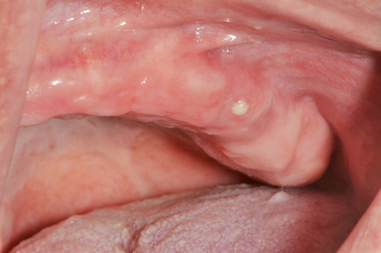 Abb. 2 Sondierbarer Knochen Regio 25 mit infektiösen Entzündungszeichen (Pus).