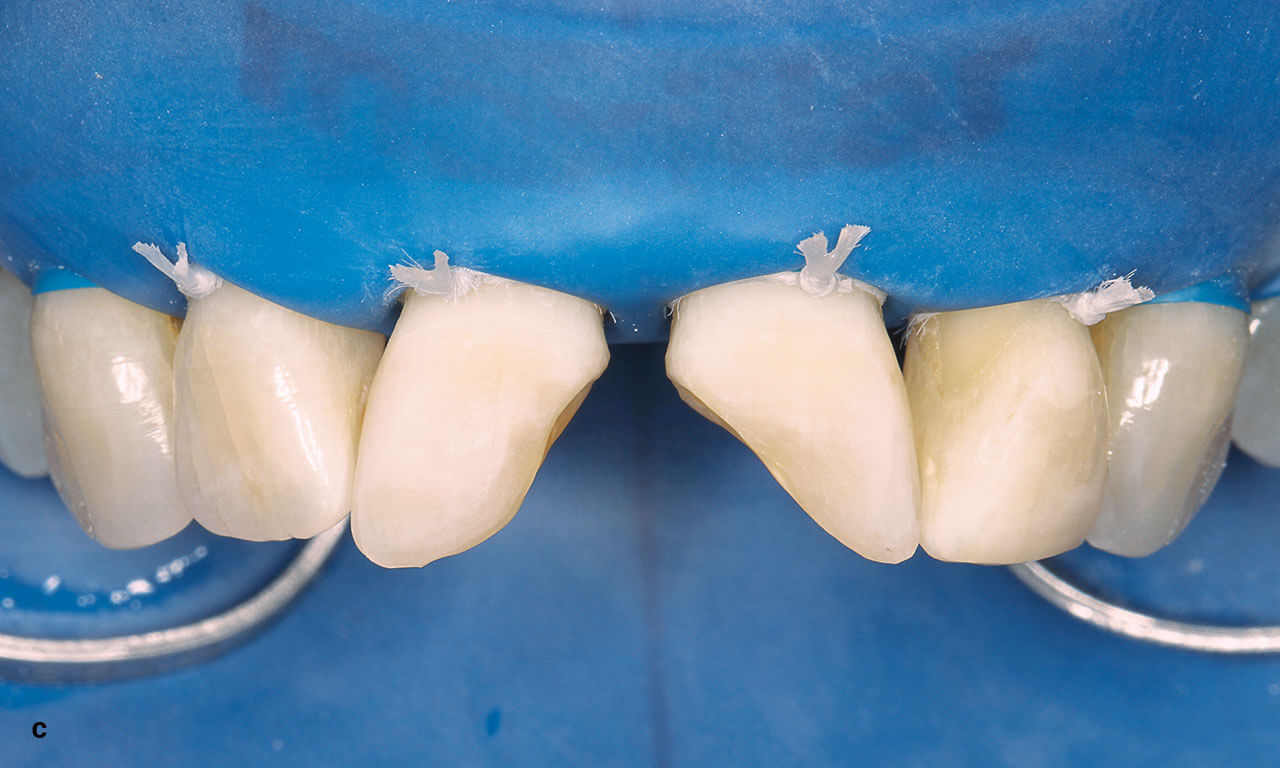 Abb. 1c Oberkieferfront nach Entfernung der alten Restaurationen an 11 und 21 unter Kofferdam mit gelegten Ligaturen.