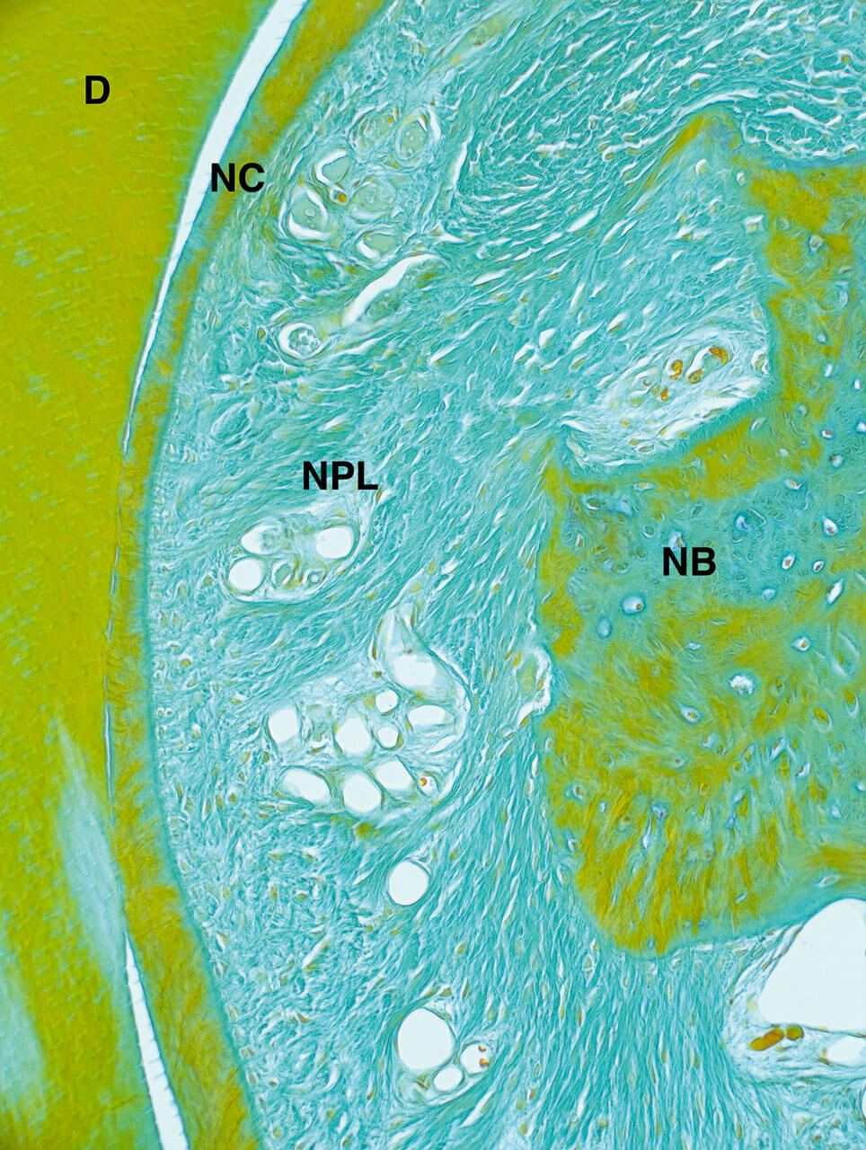 Abb. 2 Die Vergrößerung des in Abbildung 1 dargestellten Defekts verdeutlicht die Neubildung von Zement (NC), Desmodont (NPL) und Knochen (NB). 