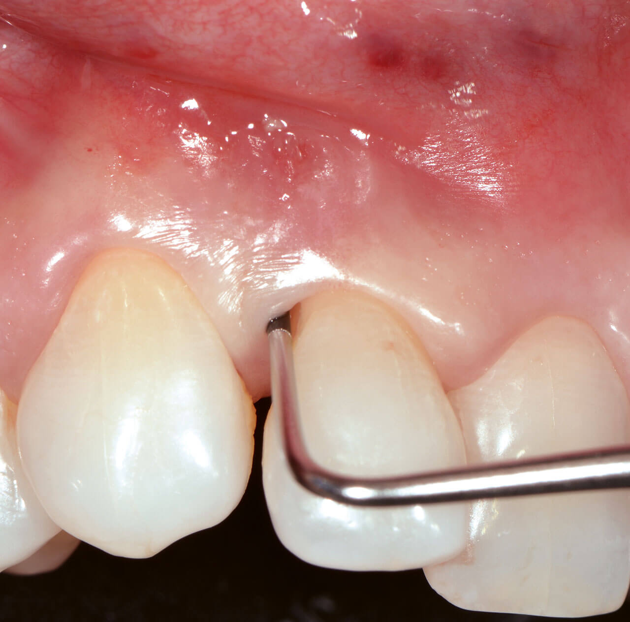 Abb. 3  Die präoperative Situation zeigt eine stark erhöhte Sondierungstiefe am Zahn 12.