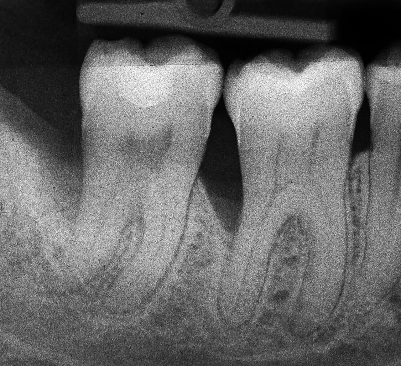 Abb. 11  Das präoperative Röntgenbild lässt zwei tiefe intraossäre Defekte distal der Zähne 46 und 47 erkennen.