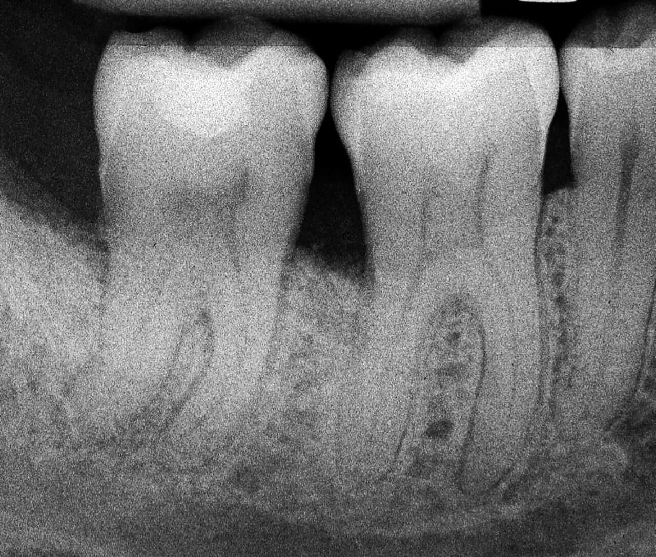 Abb. 14  Die intraoperative Röntgenaufnahme 2 Jahre nach Therapie zeigt eine fast komplette knöcherne Auffüllung der intraossären Komponenten an den Zähnen 46 und 47.