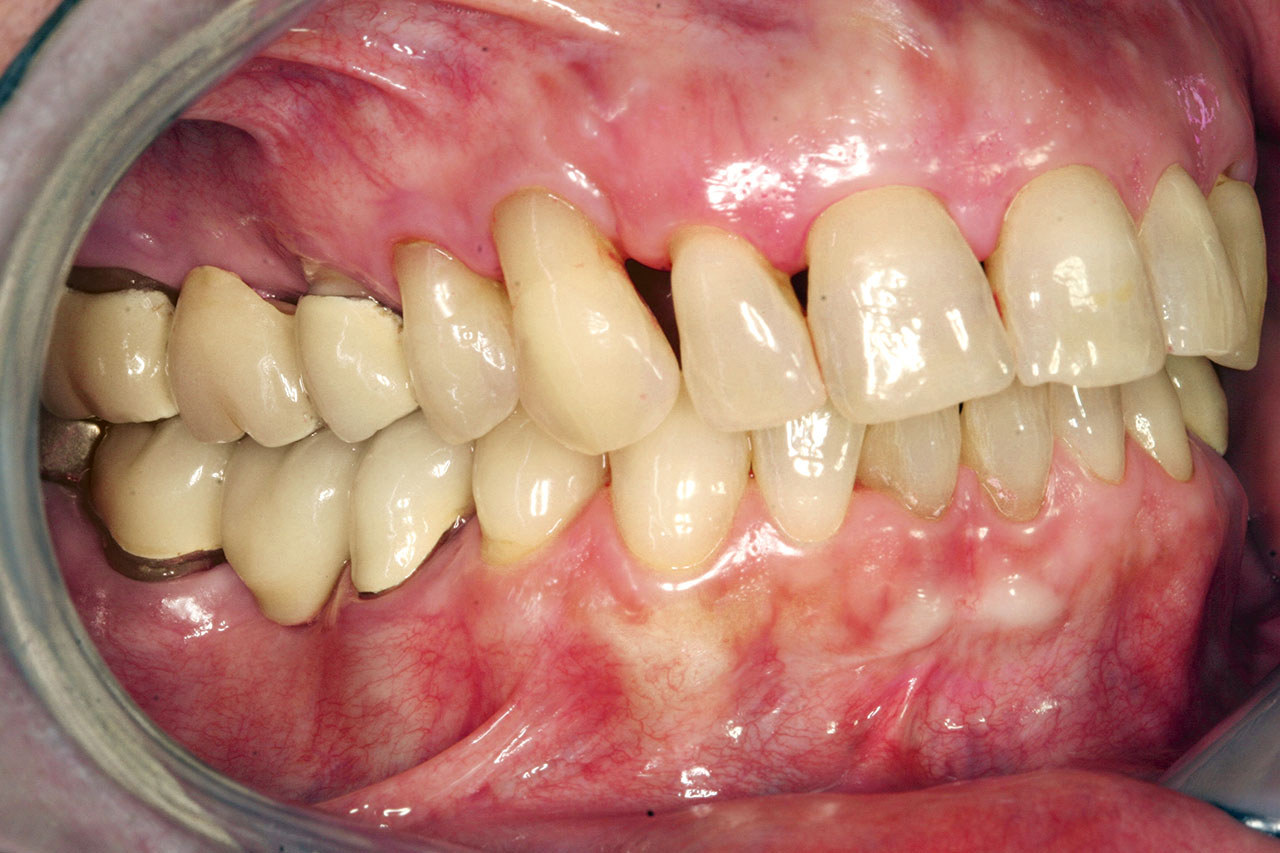 Abb. 2c und d Ein Röntgen­status aus dem Jahr 2013 zeigt Wurzel­kanalfüllungen an den Zähnen 26, 27, 37 und 47. Zahn 28 wurde inzwischen extrahiert. Klinisch liegen eine lokali­sierte Blutung auf Sondieren (18 %), ST generalisiert zwischen 1 und 5 mm und ausgerichtete Oberkieferfrontzähne mit im Vergleich zum Ausgangszustand reduzierten „schwarzen Dreiecken“ zwischen den Zähnen 13 bis 11 vor (c und d).