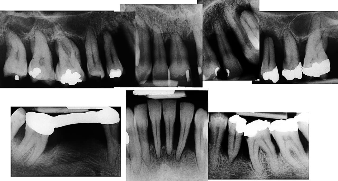Abb. 1 Patientenfall aus Greifswald: Ausgangsbefund aus dem Jahr 1996 (oben) einer 35-jährigen, sehr ängstlichen Patientin, die zum damaligen Zeitpunkt Nichtraucherin war und vor Therapiebeginn 28 Zähne hatte. 2018 – 22 Jahre nach der antiinfektiösen Therapie (nichtchirurgisch und chirurgisch) (Befund unten; vgl. auch Tab. 1)  und damit nach einem 3-mal längeren Zeitraum als dem durchschnittlichen Beobachtungszeitraum aller aus GW eingeschlossenen Patienten – kommt die Patientin regel­mäßig 3- bis 4-mal im Jahr zur UPT. Sie erhielt nach Abschluss der aktiven Therapiephase und Extraktion von 14 Zähnen zunächst eine provisorische Brücke in Ober- und Unterkiefer zur Beurteilung der Wundheilung. Nach einem Jahr wurde diese in eine definitive Versorgung auf 13 Pfeilern (+ einem weiteren einzelnen Zahn) überführt.