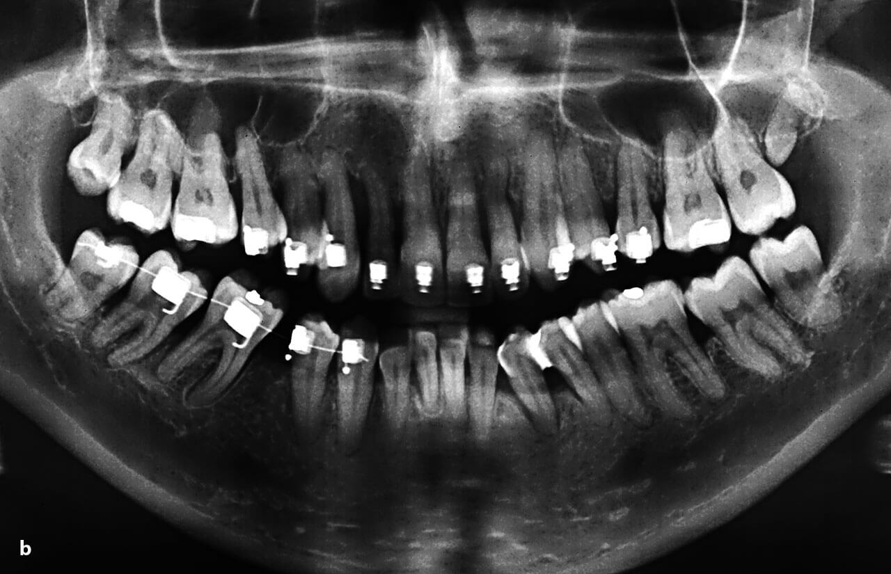 Abb. 2b Patientenfall aus Frankfurt am Main: 10-Jahres-Befund vom 05.07.2017 nach systematischer Parodontitis­therapie mit adjuvanter Antibiose (entsprechend den Angaben in Tab. 1) und 39 UPT-Sitzungen mit 30 Zähnen. Zahn 45 wurde am 31.08.2016 aus kiefer­orthopädischen Gründen extrahiert. Die Diagnose lautete: stabile Parodontitis­patientin (generalisiertes Stadium III, Grad C) mit durchschnittlichen ST von 3–4 mm (max. 5 mm) und Attachmentverlusten von 4–5 mm (max. 8 mm) mit vereinzelten Lockerungen des Grades I. Die Patientin ist inzwischen Nichtraucherin.