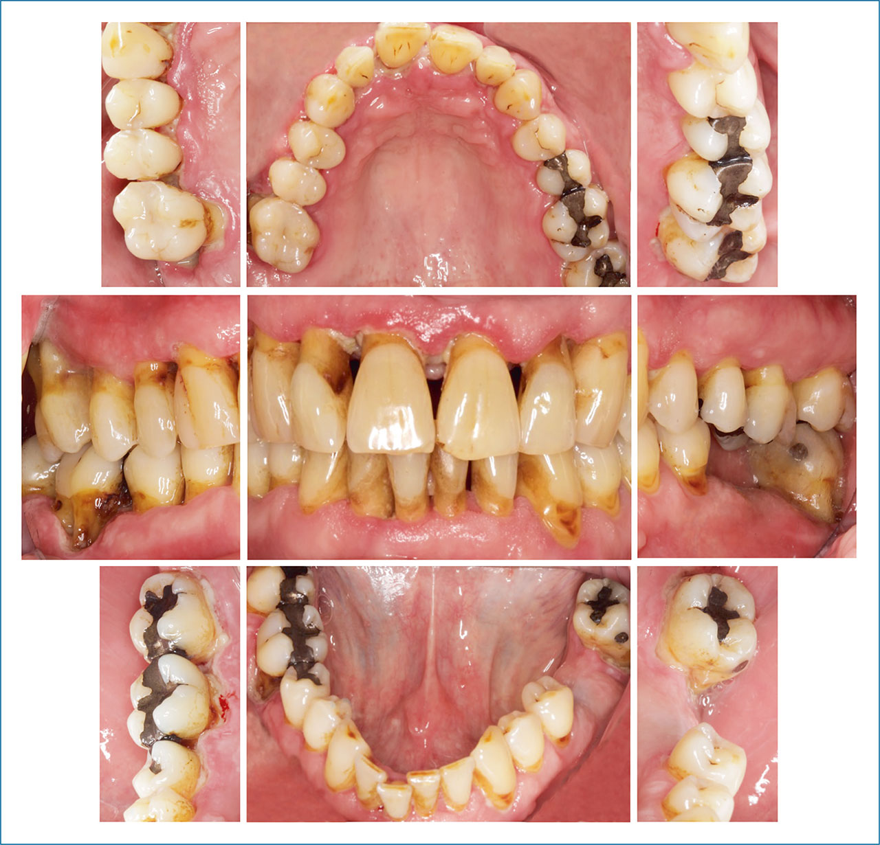 Abb. 1 Klinische Ansicht zum Zeitpunkt der initialen Befundaufnahme (Juni 2014)1.Die Fotos wurden vor Durchführung einer professionellen Zahnreinigung erstellt.