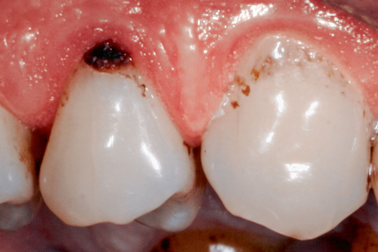 Abb. 1a Verschiedene Erscheinungsformen von Wurzelkaries: Wurzelkariesläsion mit einer Kavitation < 0,5 mm an Zahn 14 (ICDAS-Code: W1); aufgrund der lederartigen Konsistenz der Oberfläche wurde die Läsion als aktiv klassifiziert; ...