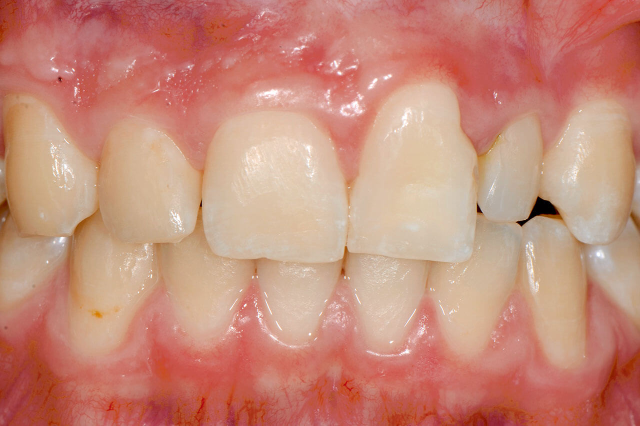 Abb. 1  Ausgangssituation linksseitige Lippen-KieferGaumen-Spalte (LKG-Spalte) nach kieferorthopädischem (KFO-)Lückenschluss. Unterschiedliche Achsneigung und Breite der Zähne 11 und 21, hypoplastischer Zahn 22.