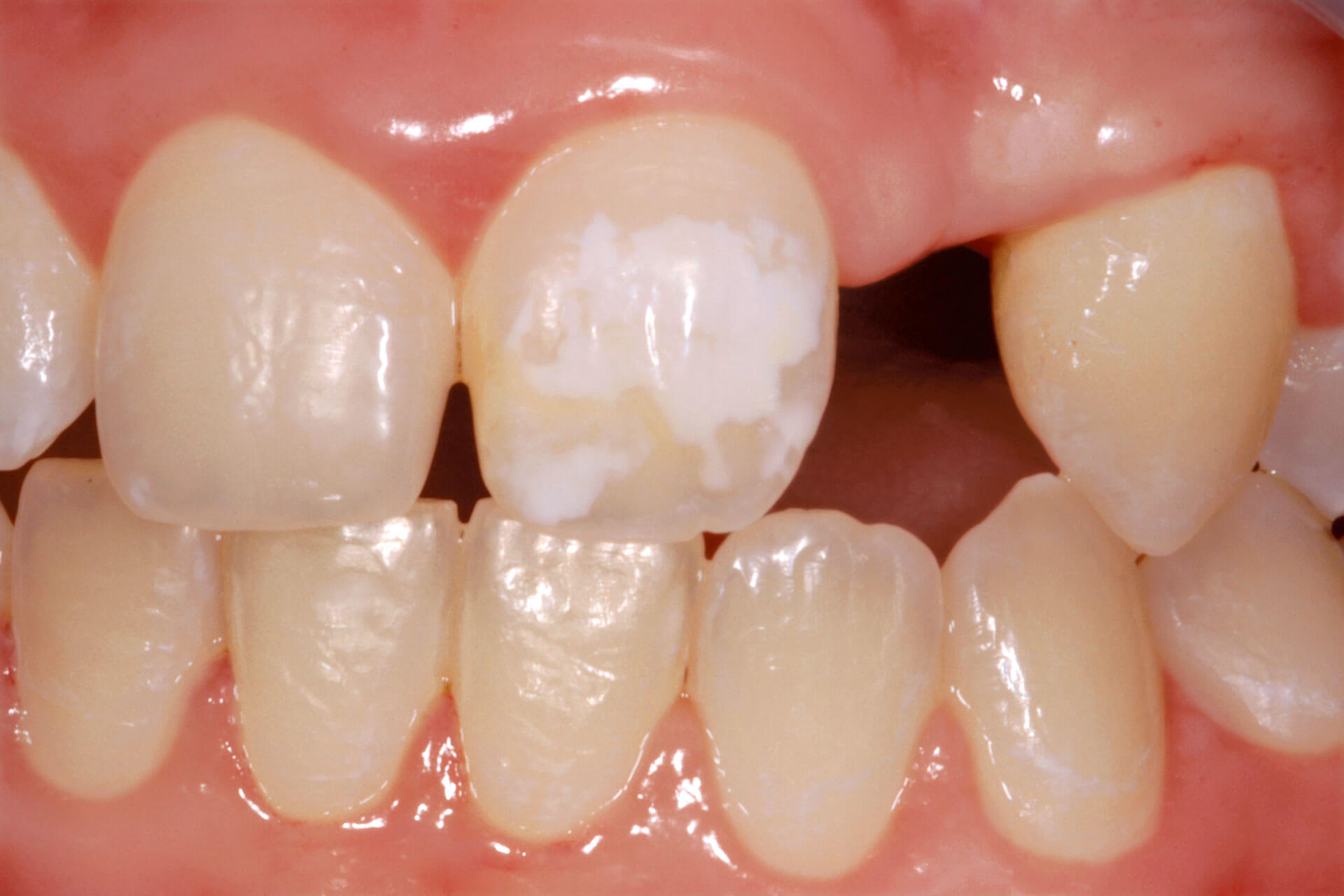 Abb. 8 Linksseitige LKG-Spalte mit Nichtanlage des lateralen Inzisivi und KFO-Lückenöffnung, Schmelzhypoplasie mit Formdefekt an Zahn 21 ersichtlich.