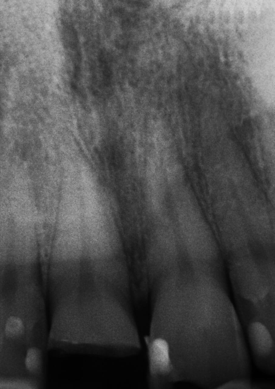 Abb. 2 Im intraoralen Röntgenbild können außer der komplizierten Kronenfraktur an Zahn 11 keine zusätzlichen Kronen- oder Wurzelfrakturen festgestellt werden.