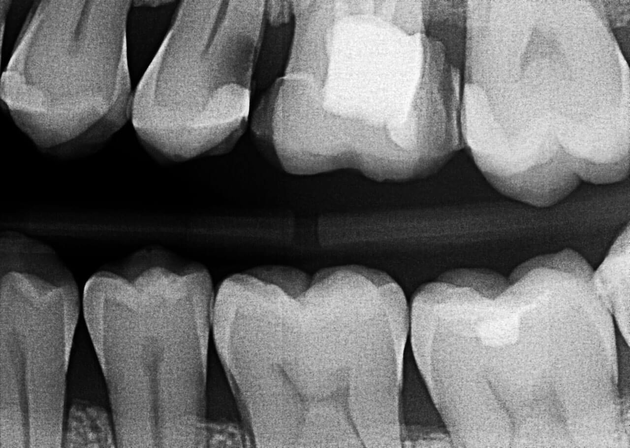 Abb. 11 Die im Zuge der Erstvorstellung angefertigte Bissflügelaufnahme zeigt eine profunde kariöse Läsion unter einer vorhandenen Kompositrestauration distal an Zahn 25.