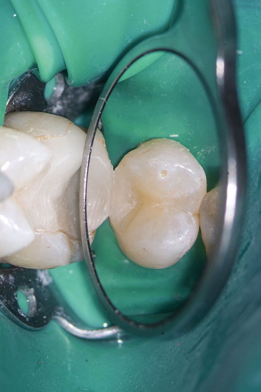 Abb. 16 Zahn 25 wurde abschließend mit einer adhäsiven Kompositfüllung restauriert.