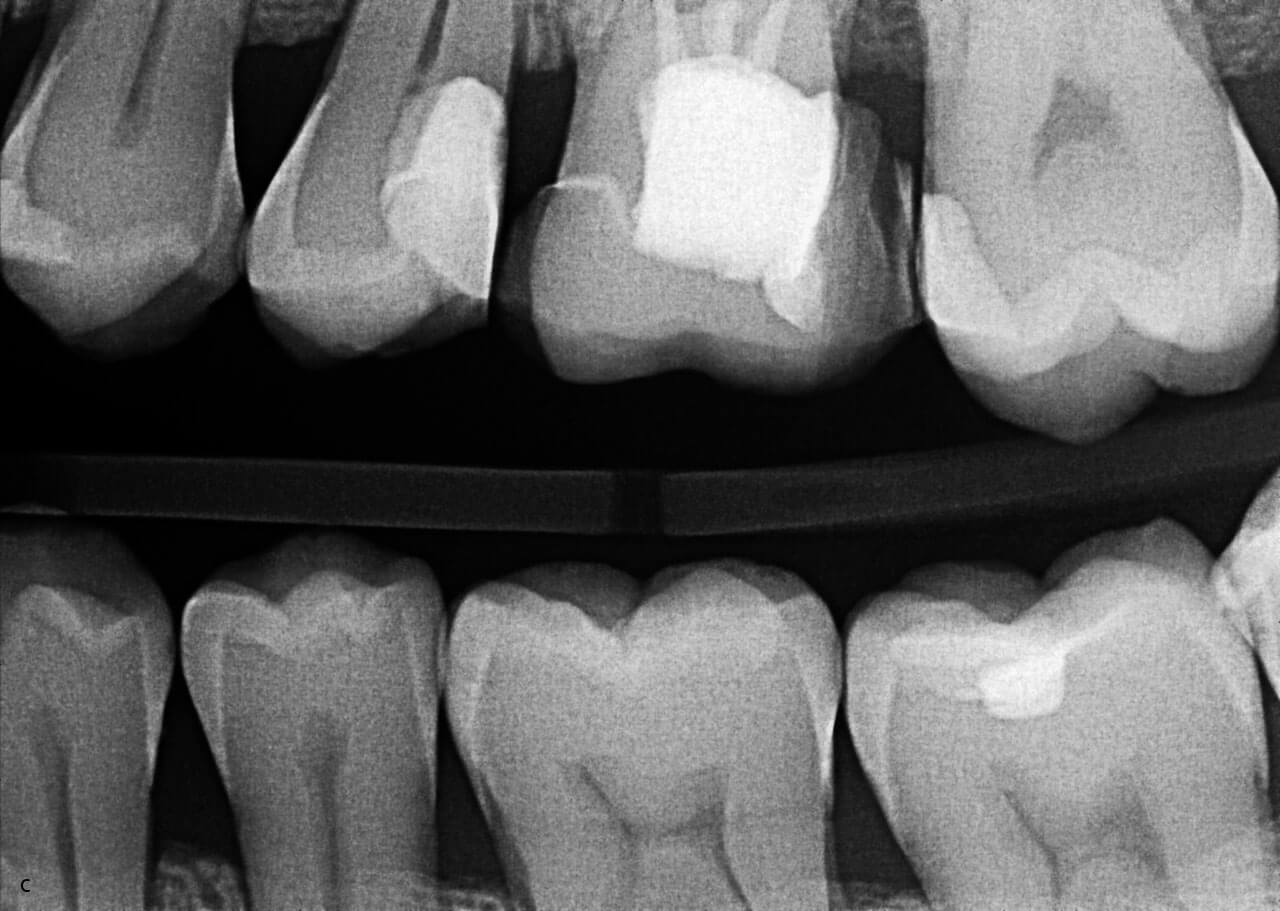 Abb. 17c In der Bissflügelaufnahme 1 Jahr nach partieller Pulpotomie lässt sich die Bildung einer Dentinbrücke zwischen Wurzelkanalsystem und dem Überkappungsmaterial nachvollziehen.
